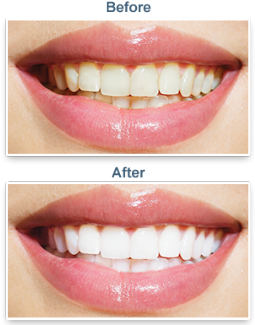 laser teeth whitening albany ny