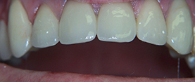 The image shows a close-up view of a person s teeth with a focus on a dental implant and surrounding natural teeth, displaying a smile.