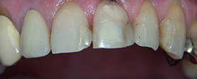 The image shows a close-up view of a person s teeth with a focus on the upper front teeth, which appear yellowed and stained, suggesting poor oral hygiene or dental issues.